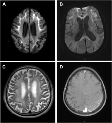 Urine cytological study in patients with clinicopathologically confirmed neuronal intranuclear inclusion disease